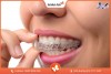 Top 10 địa chỉ niềng răng invisalign tại Sóc Trăng uy tín nhất An Toàn Hiện Nay