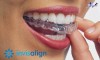 Top 10 địa chỉ niềng răng invisalign tại Thừa Thiên - Huế uy tín nhất mang những nụ cười tươi mát, hơi thở thơm tho