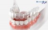 Top 10 địa chỉ niềng răng invisalign tại Trà Vinh uy tín nhất Chất Lượng Tốt – Giá Phải Chăng