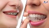 Top 10 địa chỉ niềng răng invisalign tại Yên Bái uy tín nhất Được Đánh Giá Cao Nhất