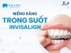 Top 5 địa chỉ niềng răng invisalign tại Phan Thiết Bình Thuận uy tín nhất áp dụng công nghệ tiên tiến