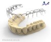 Top 5 địa chỉ niềng răng invisalign tại Quy Nhơn Bình Định uy tín nhất mang tính thẩm mỹ cao (1)