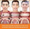 Top 6 địa chỉ niềng răng invisalign tại Đông Hà Quảng Trị uy tín nhất biến nụ cười bạn trở nên hoàn thiện hơn (1)