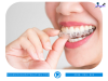 Top 6 địa chỉ niềng răng invisalign tại Lào Cai uy tín nhất cam kết các dịch vụ uy tín