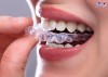 Top 7 địa chỉ niềng răng invisalign tại Nam Định uy tín nhất sử dụng nhiều công nghệ tiên tiến (1)