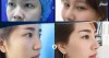 Top Địa chỉ nâng mũi đẹp Hà Giang và an toàn nhất Hà Giang đẹp như ý
