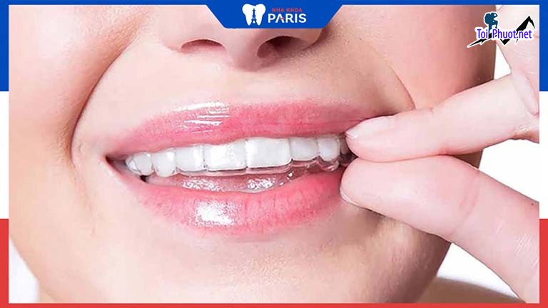 Top 10 địa chỉ niềng răng invisalign tại Hà Giang uy tín nhất càng ngày càng phát triển (1)