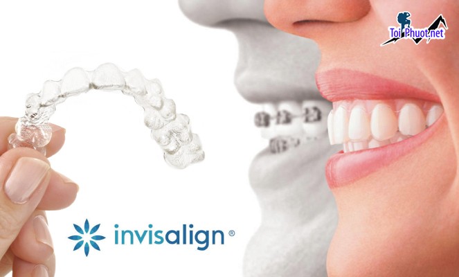 Top 10 địa chỉ niềng răng invisalign tại Sóc Trăng uy tín nhất An Toàn Hiện Nay (2)