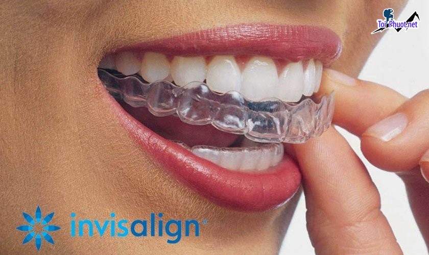 Top 10 địa chỉ niềng răng invisalign tại Thừa Thiên   Huế uy tín nhất mang những nụ cười tươi mát, hơi thở thơm tho  (1)