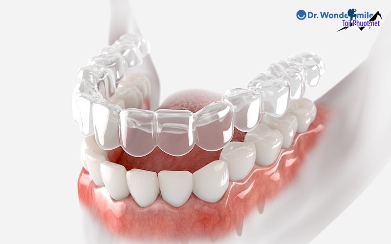 Top 10 địa chỉ niềng răng invisalign tại Trà Vinh uy tín nhất Chất Lượng Tốt – Giá Phải Chăng (3)