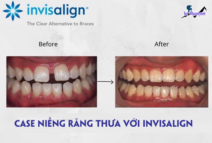 Top 10 địa chỉ niềng răng invisalign tại Việt Trì Phú Thọ uy tín nhất có chuyên môn tay nghề cao (2)