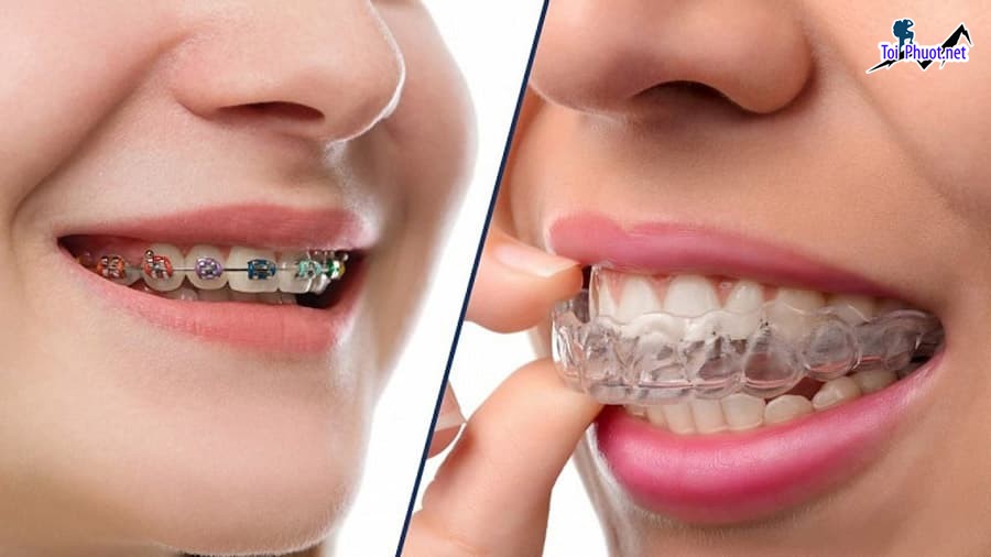 Top 10 địa chỉ niềng răng invisalign tại Yên Bái uy tín nhất Được Đánh Giá Cao Nhất (2)