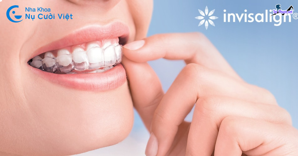 Top 4 địa chỉ niềng răng invisalign tại Bến Tre uy tín nhất để có một hàm răng đẹp