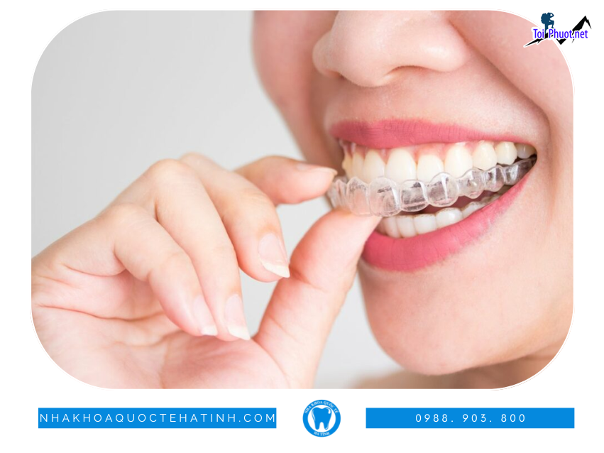 Top 4 địa chỉ niềng răng invisalign tại Cao Bằng uy tín nhất có kết quả tối ưu (1)