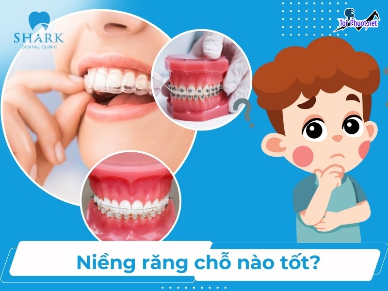 Top 5 địa chỉ niềng răng invisalign tại Cà Mau uy tín nhất mang đến hiệu quả tối đa (1)