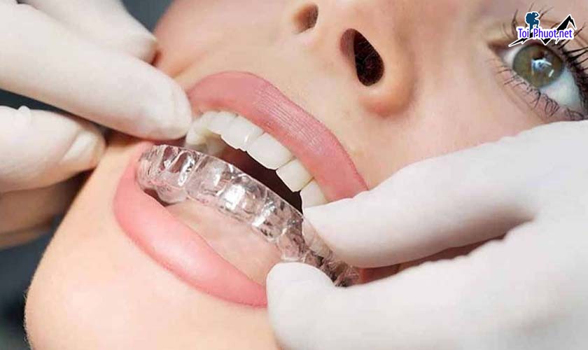 Top 6 địa chỉ niềng răng invisalign tại Tuyên Quang uy tín nhất cực kì hiệu quả (2)