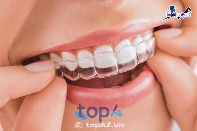 Top 7 địa chỉ niềng răng invisalign tại Tuy Hòa Phú Yên uy tín nhất Được Nhiều Người Tin Tưởng (3)