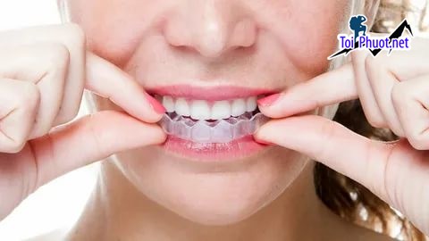 Top địa chỉ niềng răng invisalign tại Rạch Giá Kiên Giang uy tín nhất có thể tin dùng khi đến đây (2)