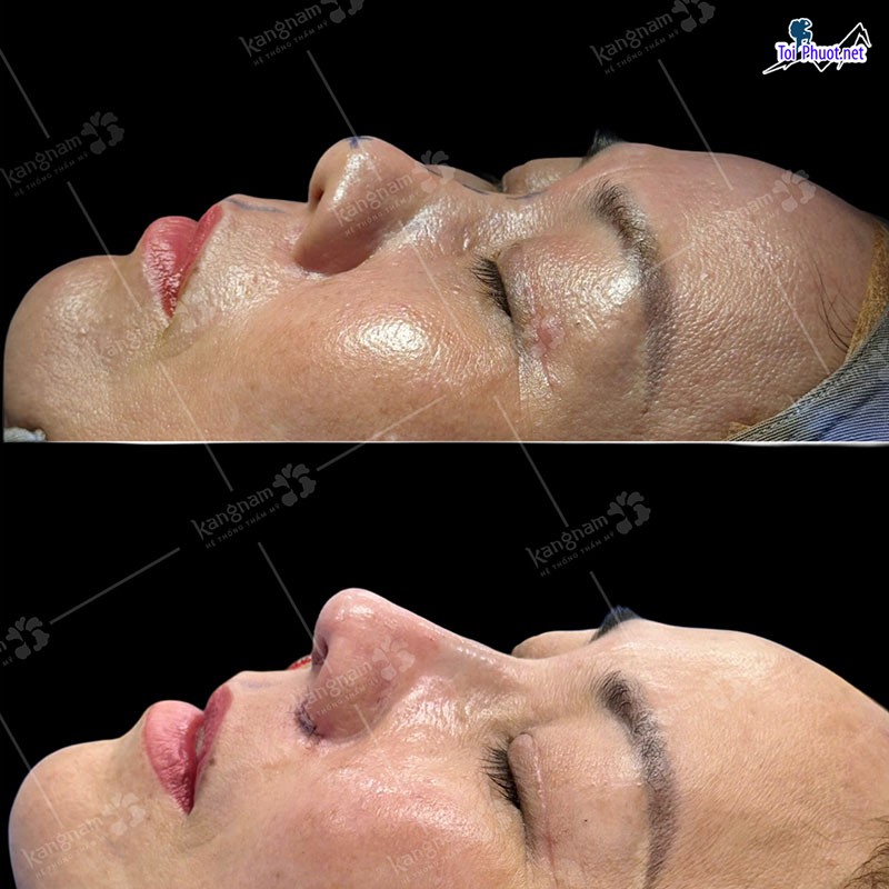 Top 12 Địa chỉ Lai Châu nâng mũi đẹp và an toàn nhất phù hợp khuôn mặt (3)