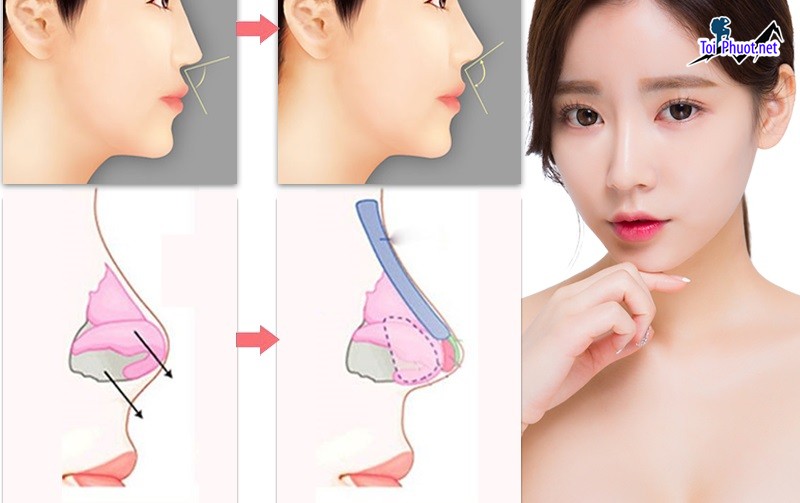 Top 12 Địa chỉ nâng mũi đẹp và an toàn nhất Hải Dương dáng mũi chuẩn đẹp (2)