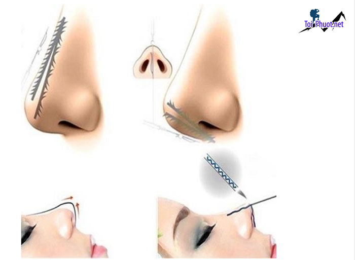 Top 12 Địa chỉ nâng mũi đẹp và an toàn nhất Lạng Sơn được hỗ trợ tư vấn