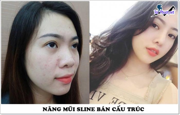 Top 3 Địa chỉ nâng mũi Cao Lãnh Đồng Tháp đẹp và an toàn nhất mang đến kết quả như ý (3)