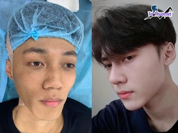 Top 4 Địa chỉ nâng mũi đẹp và an toàn nhất Ninh Bình cho bạn xinh đẹp rạng rỡ (2)