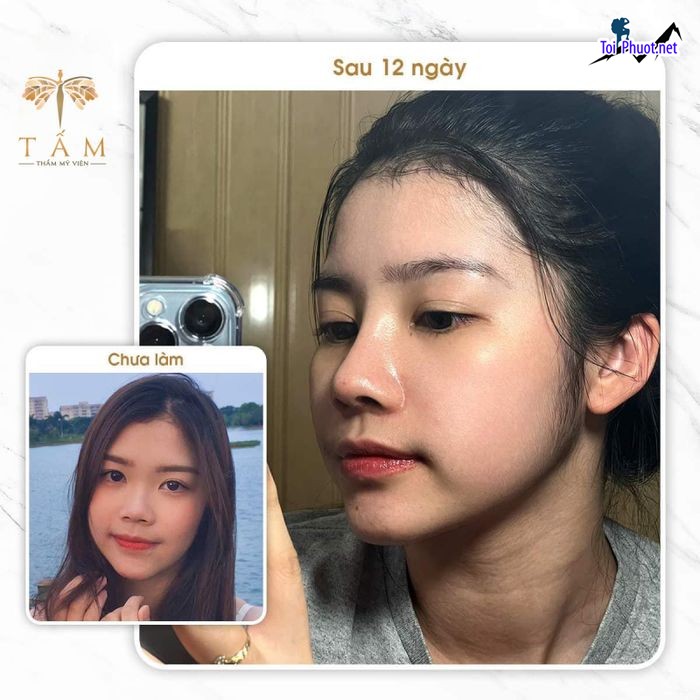 Top 5 Địa chỉ nâng mũi đẹp Pleiku Gia Lai và an toàn nhất vẻ đẹp bền vững (1)
