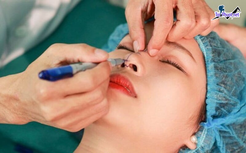 Top 5 Địa chỉ nâng mũi đẹp và an toàn nhất Việt Trì Phú Thọ an toàn tuyệt đối (1)