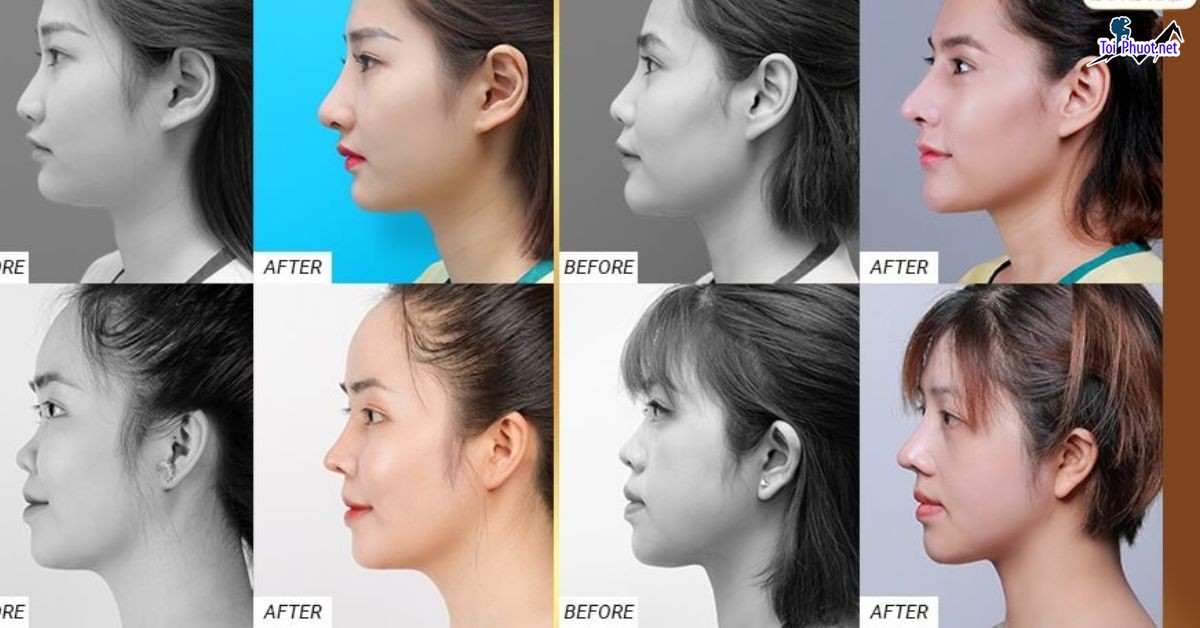 Top Địa chỉ nâng mũi đẹp Hà Giang và an toàn nhất Hà Giang đẹp như ý (2)