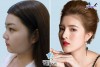 Top 6 Địa chỉ nâng Quy Nhơn Bình Định mũi đẹp và an toàn nhất khách hàng tin tưởng