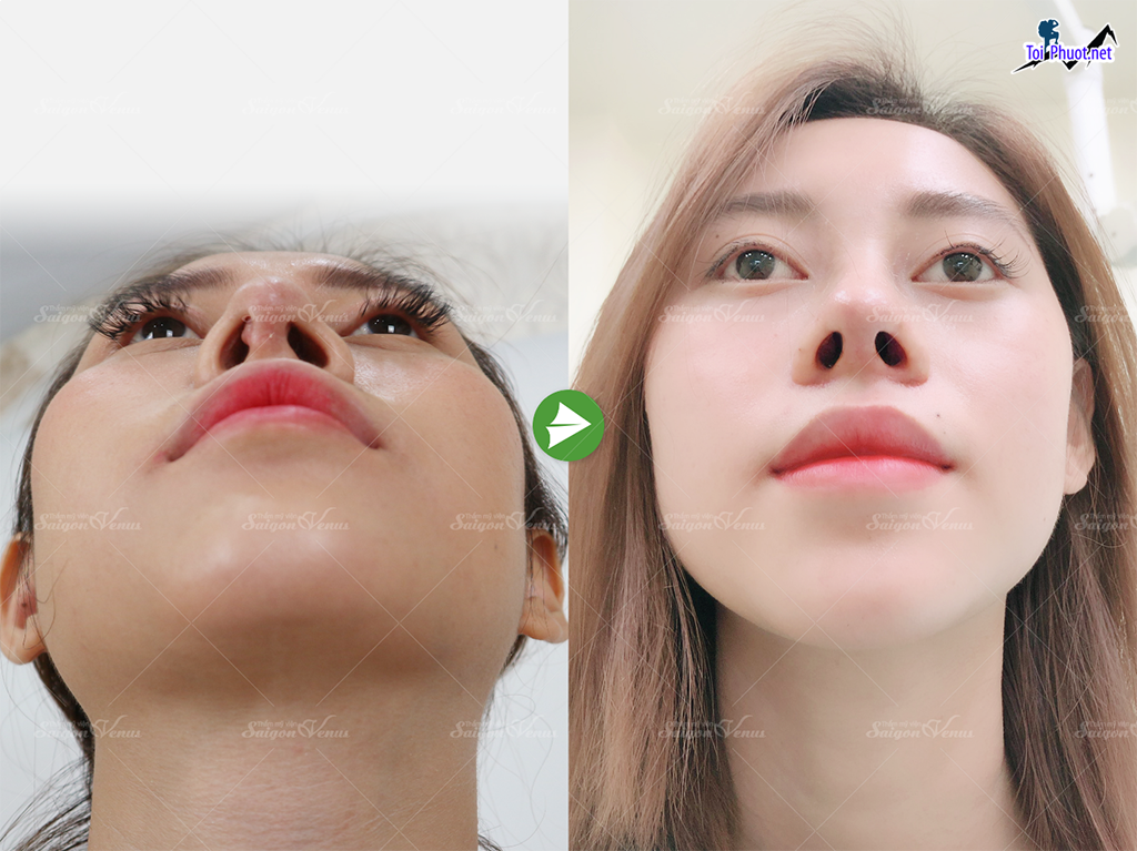 Top 4 Địa chỉ nâng mũi đẹp và an toàn nhất Bến Tre cơ sở nổi tiếng