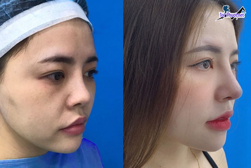 Top 6 Địa chỉ nâng Quy Nhơn Bình Định mũi đẹp và an toàn nhất khách hàng tin tưởng (2)