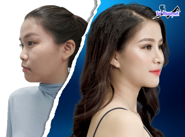 Top 6 Địa chỉ nâng Quy Nhơn Bình Định mũi đẹp và an toàn nhất khách hàng tin tưởng